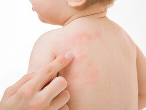 Child with Eczema