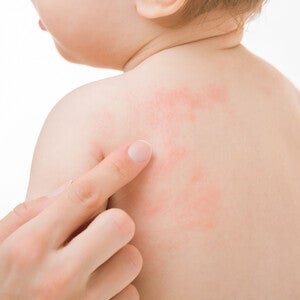 Child with Eczema