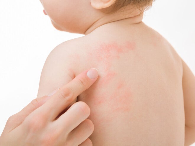 Child with Eczema