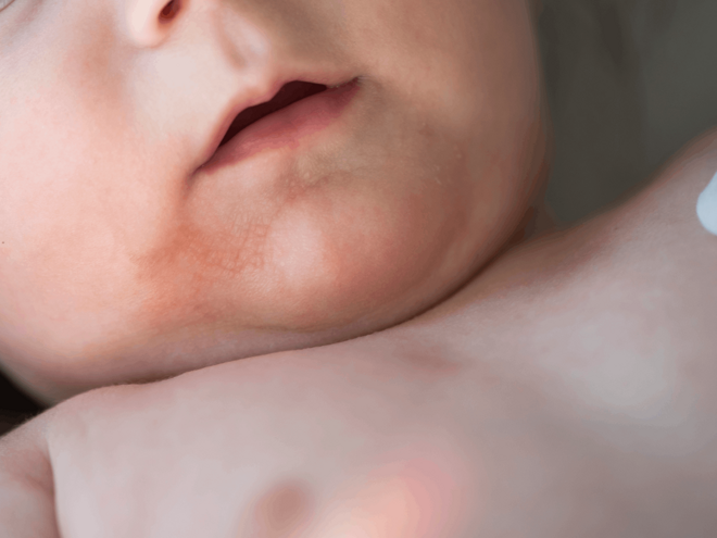 Шкіра малюка з висипом